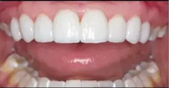 cerec-after-one