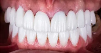 cerec-after-two