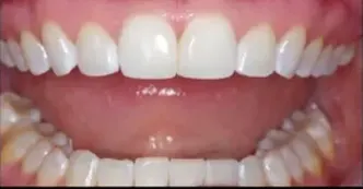 cerec-before-one