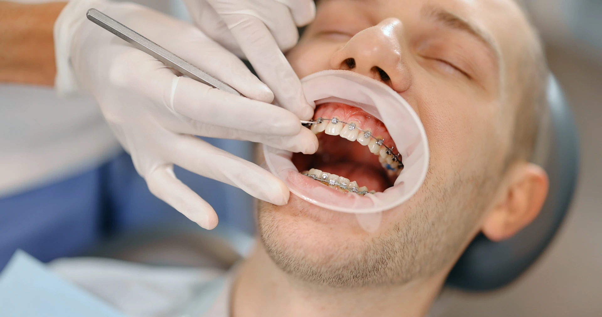 Young male patient with dental braces during a regular orthodontic visit. Dentist adjusting orthodontic brackets, close-up on patient's mouth. 4k video screenshot, please use in small size