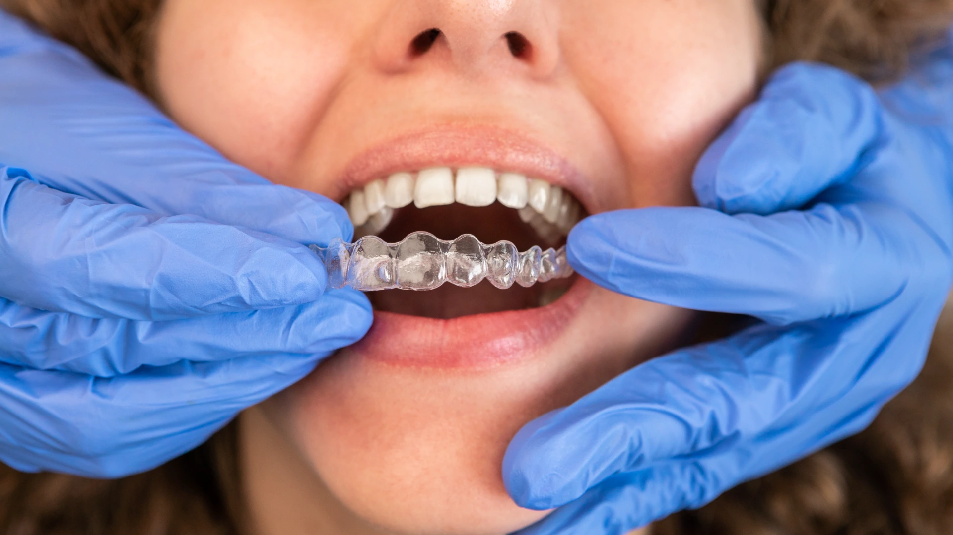 Dentist in gloves applying invisible aligner on female patient teeth at modern clinic. Orthodontic removable straighteners in dentist office. Dental treatment concept.