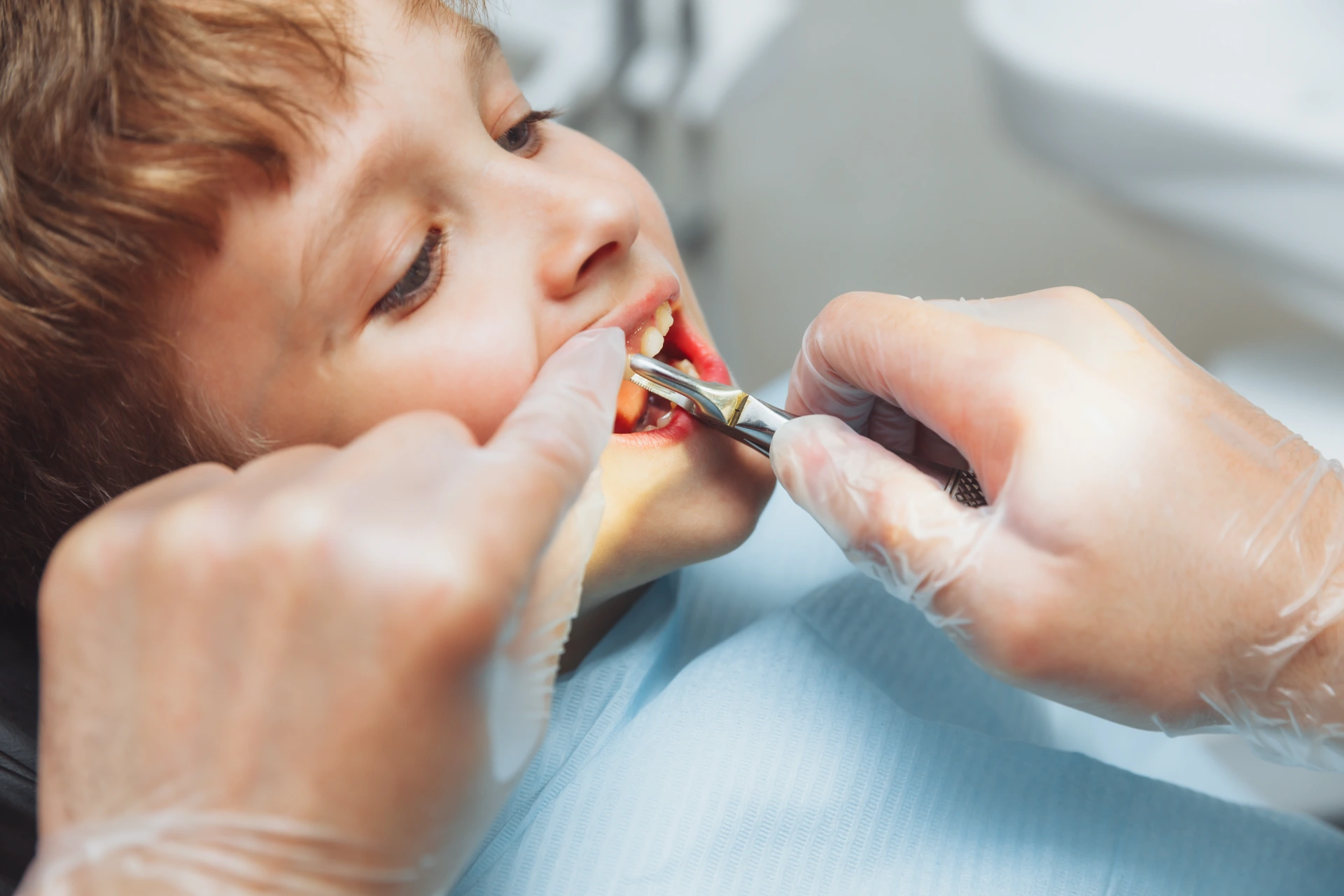 Portrait of a child patient and the hands of a pediatric dentist with dental forceps, close-up. painless extraction of teeth. pediatric dentistry.