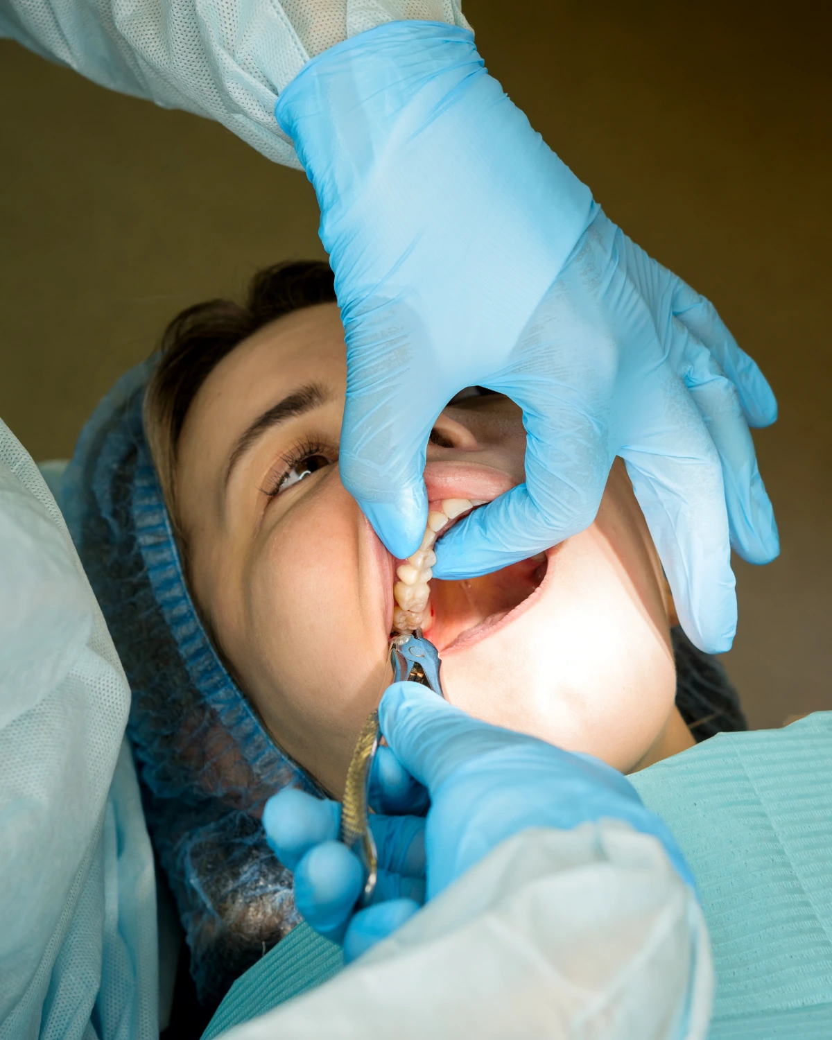 Dental surgeon removing wisdom tooth, the maxillary third molar female patient's. Real procedure. Close up image