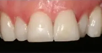 white-fillings-after-one