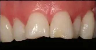 white-fillings-before-one