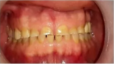 A close-up image of upper and lower teeth showing yellow discoloration, uneven alignment, and visible staining. The gums appear red and slightly inflamed, particularly along the lower gum line.