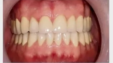 A close-up image of upper and lower teeth showing a bright, even alignment with a natural white shade. The gums appear healthy and pink, with no signs of inflammation or discoloration.