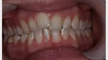 A close-up image of a full set of upper and lower teeth showing moderate crowding and misalignment. The teeth vary slightly in size and shape, with visible gum tissue above and below. The gums appear healthy with no significant inflammation.