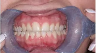 A close-up image of a person's full set of upper and lower teeth, held open with a dental retractor. The teeth are straight, evenly aligned, and clean, with healthy pink gums visible. The overall appearance indicates a well-maintained and balanced dental structure.