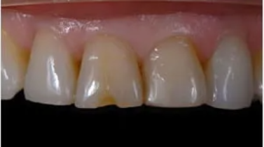 A close-up image of four upper front teeth showing slight discoloration near the gum line and a small chip on one tooth. The gums appear healthy, with a light pink color.