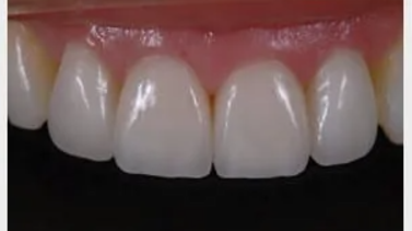 A close-up image of four upper front teeth that appear clean, well-shaped, and evenly aligned. The teeth have a smooth surface with no visible discoloration or chips. The gums look healthy and pink.