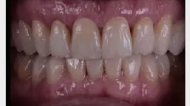 A close-up image of upper and lower teeth showing a well-aligned and clean set of teeth. The teeth appear evenly shaped, bright, and symmetrical, with healthy gums visible around them.