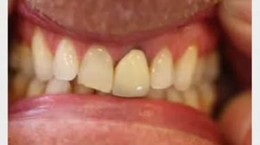 a person's upper front teeth, showing slight misalignment and visible gaps between some teeth.