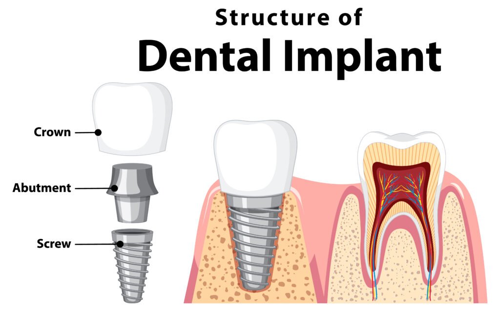 Diagram of a dental implant showing the crown, abutment, and screw beside a natural tooth.
