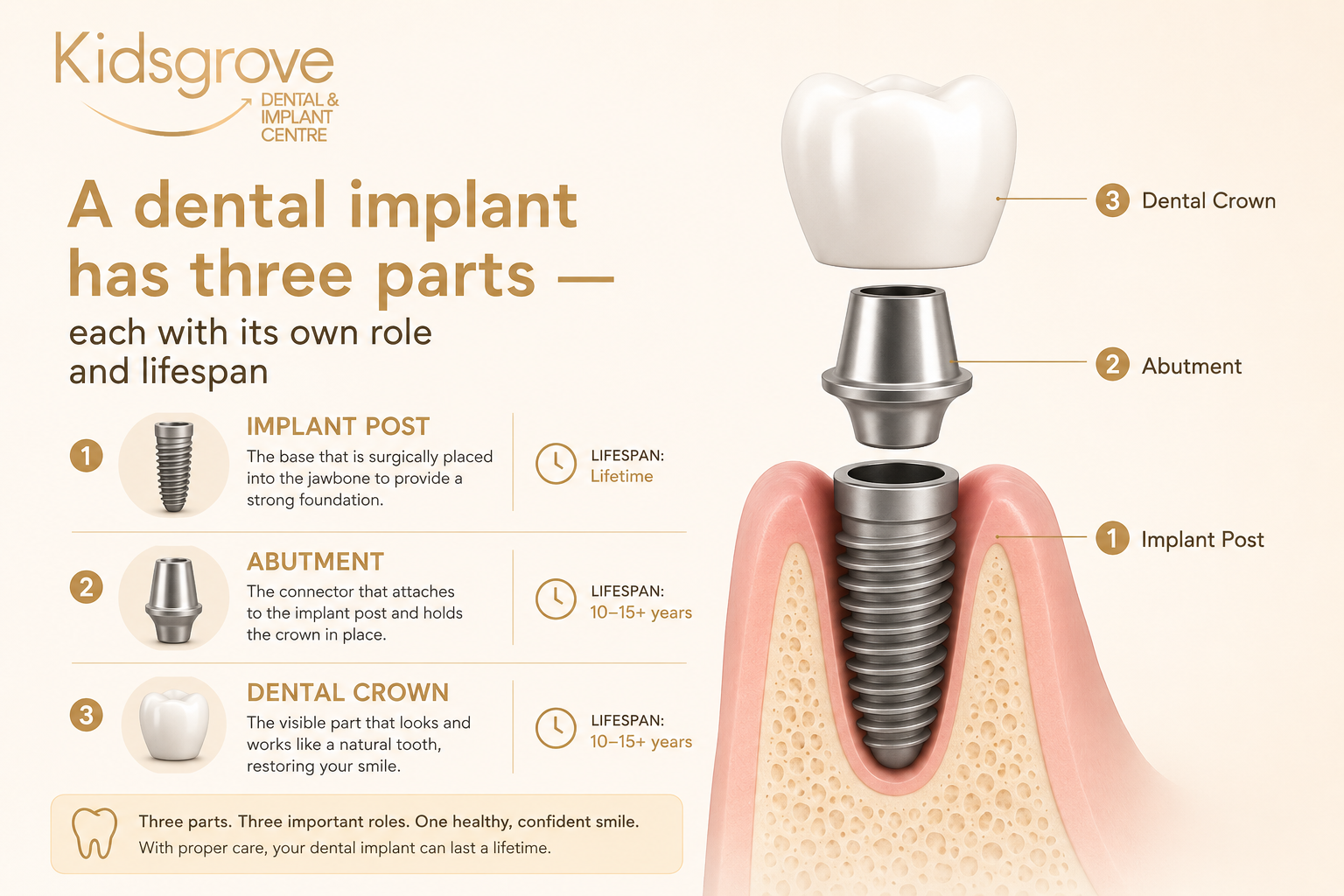 A dental implant has three parts — each with its own role and lifespan