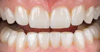 cerec-after-three.webp