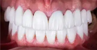 cerec-after-two.webp