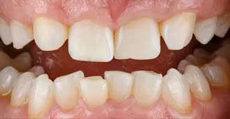 cerec-before-three.webp
