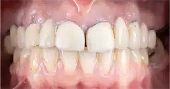 cerec-before-two.webp