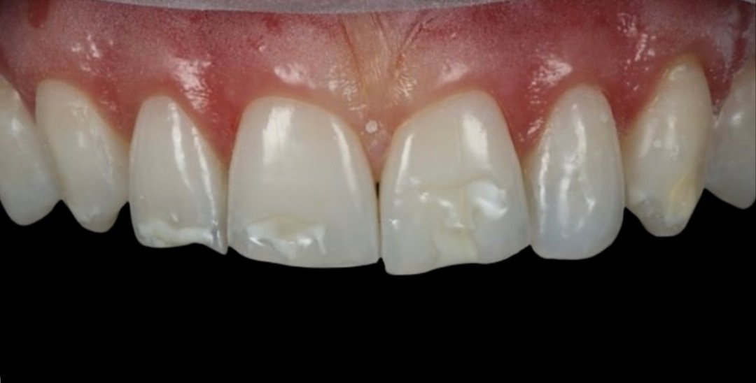 veneer-a-1.jpg