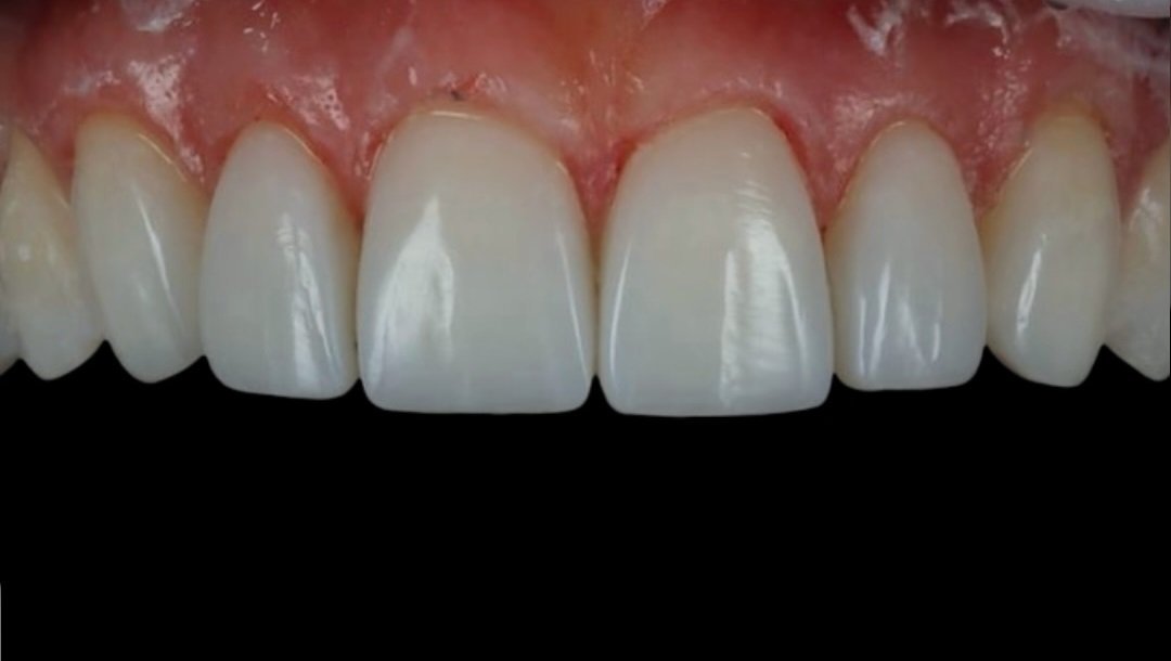 veneer-b-1.jpg